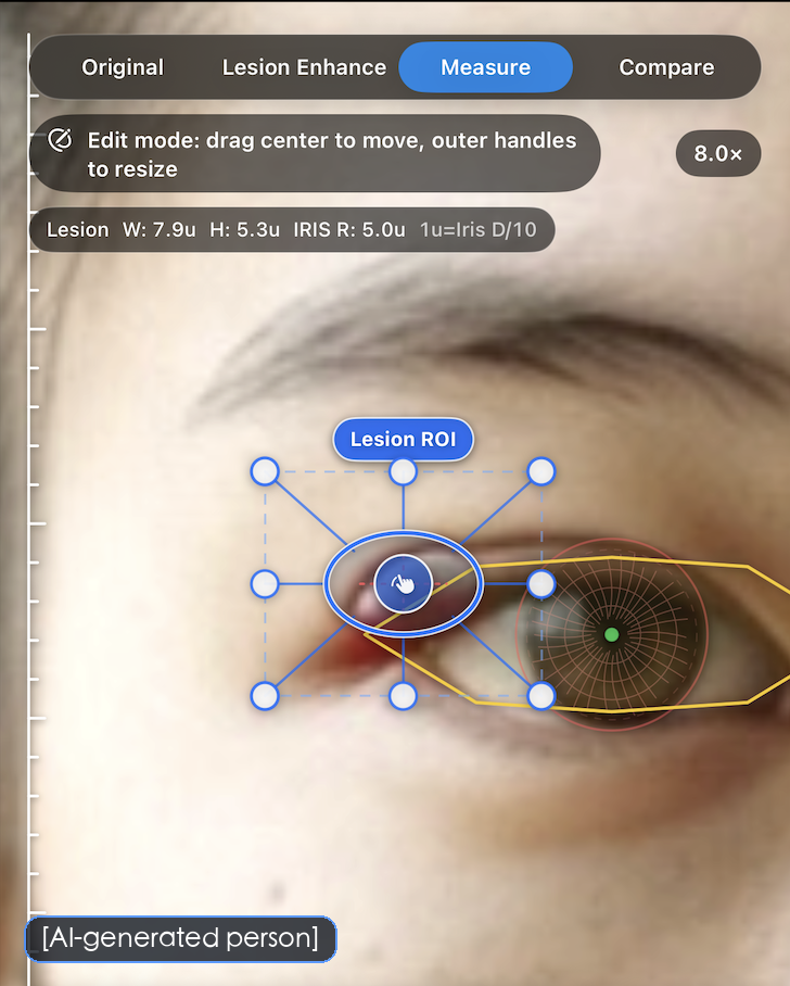 LidTrack measurement screen marking the iris and selected area